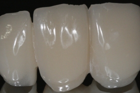 CAM/CAM Ideiglenes PMMA