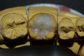 Inlay E.max