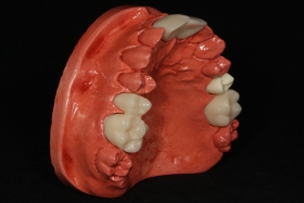 CAM/CAM Ideiglenes PMMA